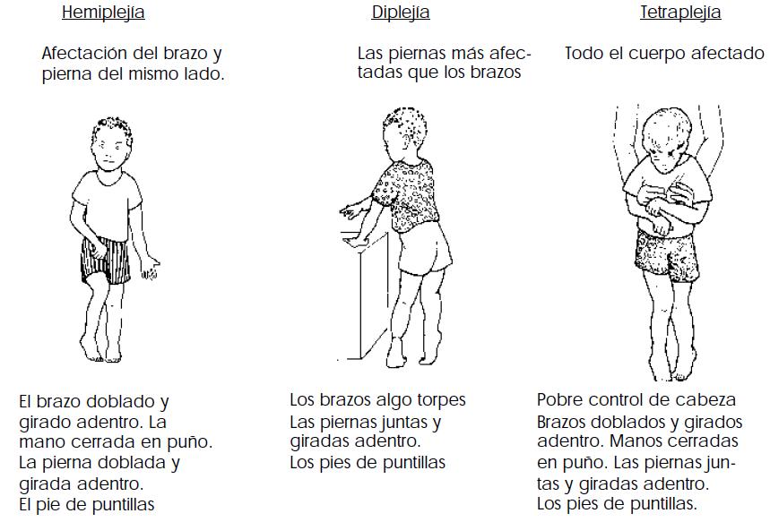 Fomento del Desarrollo del Niño con Parálisis Cerebral, Cuadro de presentación de la afección